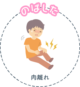 のばした 肉離れ